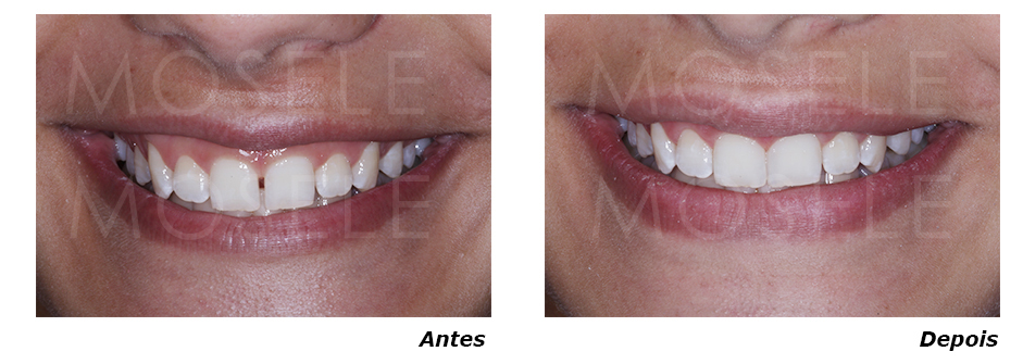 Anteriores-Diastema