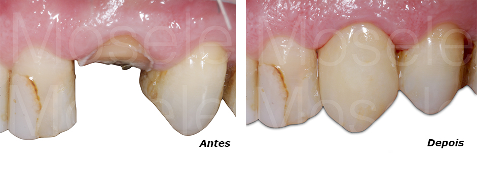 Anteriores - fratura